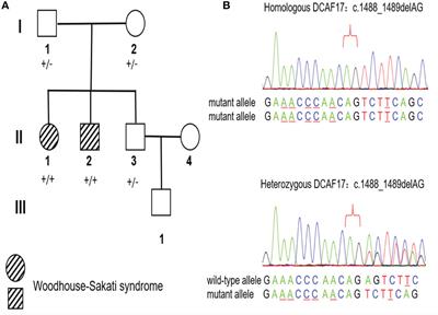 Case Report: A Chinese Family of Woodhouse-Sakati Syndrome With Diabetes Mellitus, With a Novel Biallelic Deletion Mutation of the DCAF17 Gene